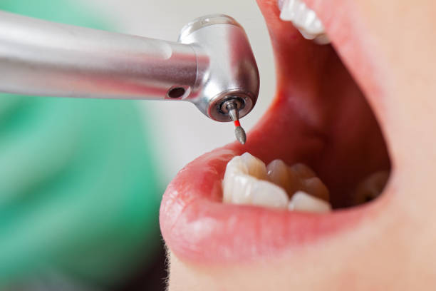 Best Emergency Treatment for Toothache in Wedgefield, FL